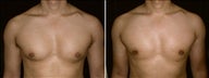31 year old male, male breast reduction