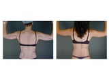 Liposuction