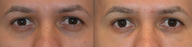 Treatment of Dark Circles Under the Eyes with Juvederm