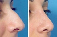 Rhinoplasty