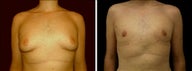 18 year old male, male breast reduction