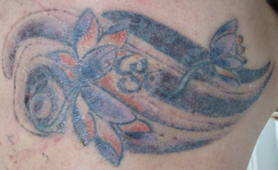 realself.comDocumenting my Tattoo Removal Using the Alex Tri Vantage ...