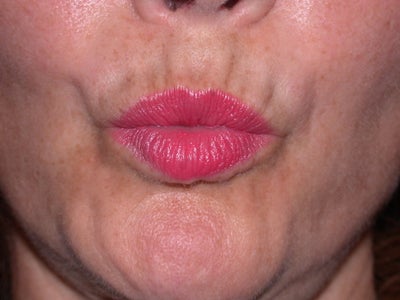 Botox Before And After Lips. Before and After Botox to
