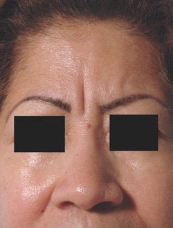 Botox+glabella+before+and+after