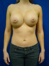 breast augmentation before after. Saline Breast Implants Before