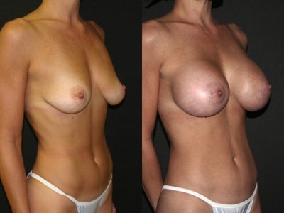 saline breast implants. Breast Implants: Saline Breast