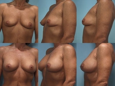 Breast Implants: Breast breast augmentation before and after c. Breast Implants: Breast