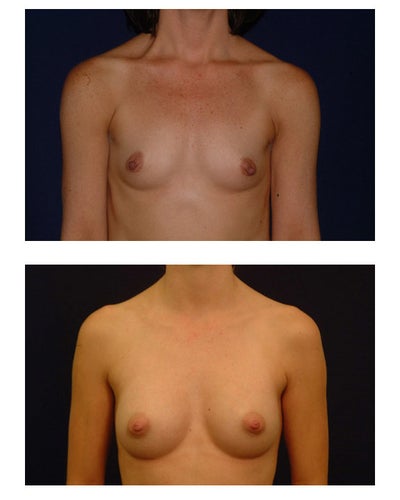 saline breast implants. saline breast augmentation 200