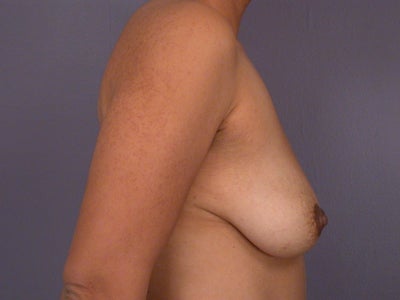 breast implants after pregnancy. Breast Lift / Breast