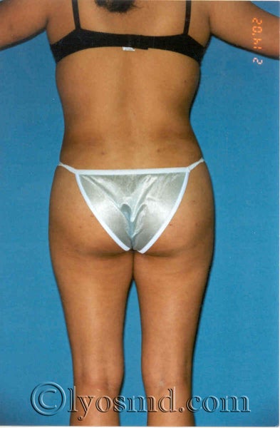 buttock implants before and after. uttock implants before and