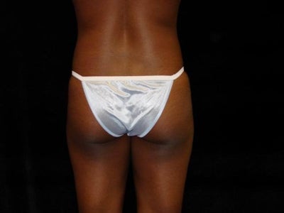 buttock implants before and after. Before. After buttock