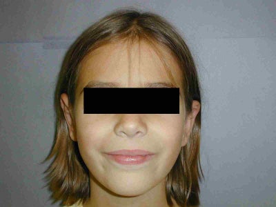 protruding nerves on face and hands