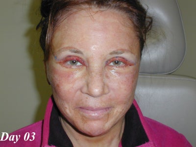 Facelift Recovery