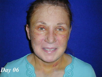 Facelift Recovery