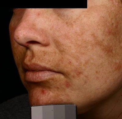 Melasma photo dermatology