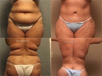 Lower+body+lift+before+and+after+photos