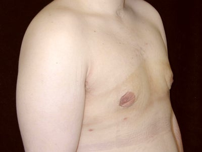 gynecomastia surgery before after. Full size - Before