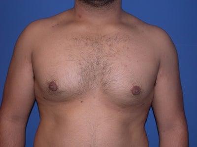 breast reduction surgery before and after. Male reast reduction: Before