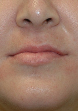 restylane lip injections before and. Restylane: Lip Augmentation