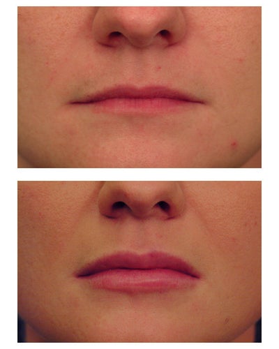 restylane lip injections before and. Restylane for lip augmentation