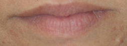 restylane lip injections before and. restylane lip injections