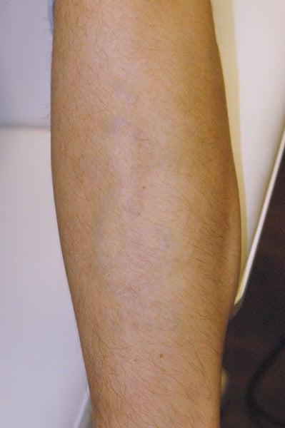 previous 10 of 26 next » · Back to Tattoo Removal Gallery »