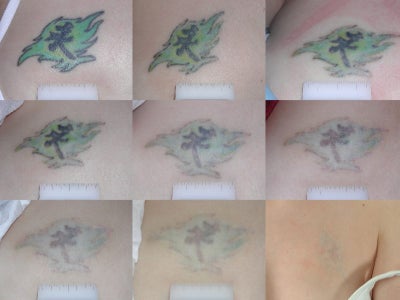 Tattoos Removal on Tattoo Removal Cost   Vanityshare Net