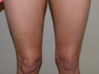 thermage before after. After Thermage to knees
