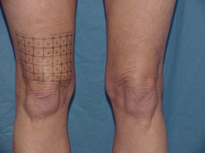 Thermage Before And After. Before Thermage to knees