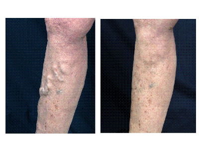 Before And After Vein Treatment. Vein treatment: EVLT