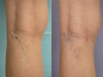 Before And After Vein Treatment. Vein treatment: Laser Vein