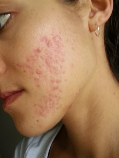 side effect from acne scarring
