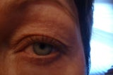 Droopy eyes