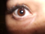 Under eye lines for 24 year old