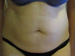 Tummy tuck vs. liposuction for more defined waist?