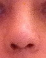 Will the pig look of my nose go away? 