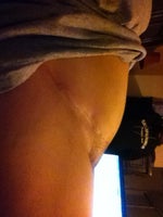 Panniculectomy 
