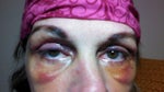 One Eyelid Feels Paralyzed!