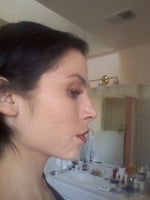 What Doctor To Choose For Silikon Acne Scar Filler? (photo)
