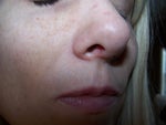 Will the swelling from tip rhinoplasty go down?