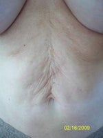 When is a plastic surgery (abdominoplasty) revision necessary