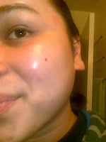 currently applying Bio-Oil and Mederma 