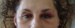 day three of surgery.Can see upper crease and fullness