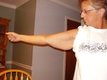 Flappy arms before surgery