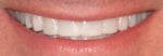 Results after having four top front teeth bonded.