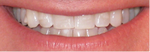 After original treatment and two refinements.  One refinement remaining.