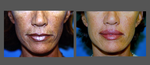 I've been looking to find the best plastic surgeon in the NY/Long Island area that specializes in lip lifts?