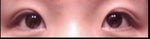 missing double eyelid