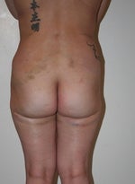 mommy makeover post op 6/23/10 flanks