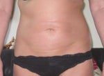June 2010 - 7 months on - can you spot the scars??
